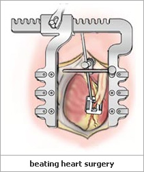 What is heart bypass surgery?