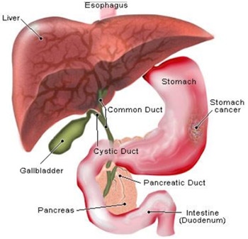 GASTRIC CANCER TUMOR MARKERS – Romanian Medical Journal